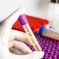 Una simple muestra de orina podría transformar el diagnóstico del cáncer de vejiga