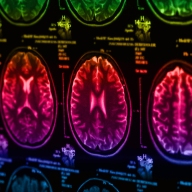 Identifican una posible estrategia terapéutica para tratar el glioblastoma